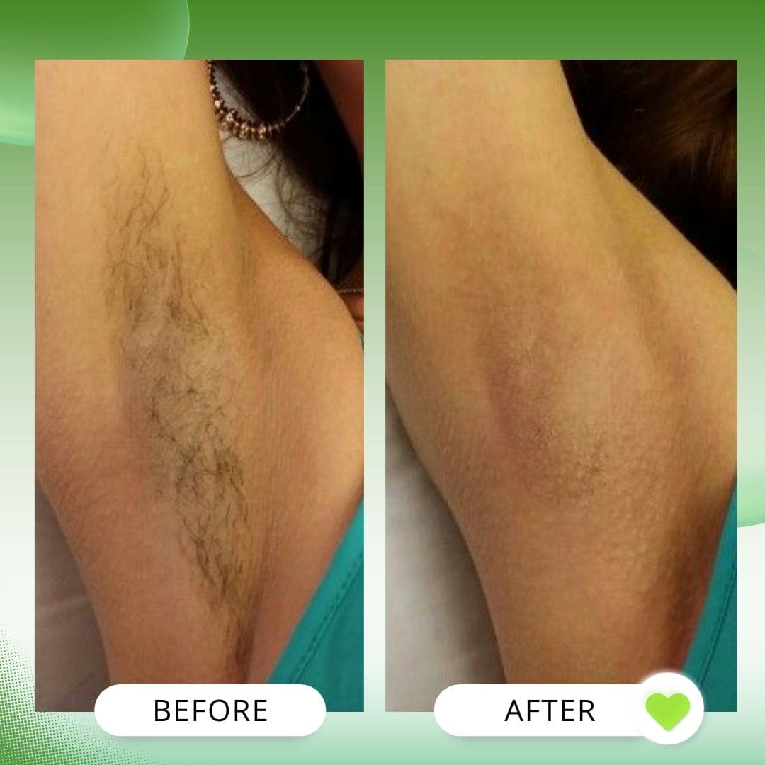 Body Hair Removal Pack